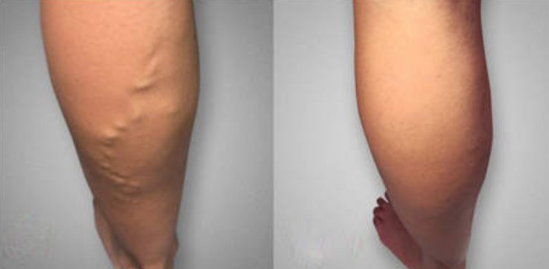 Varixil forte cena in Poland